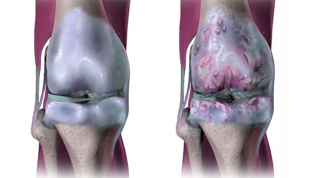 Zdravý kolenní kloub a postižený artrózou