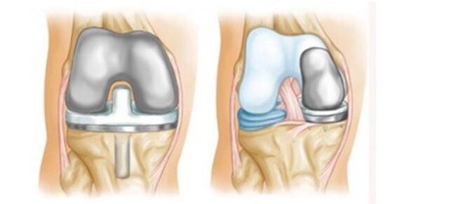 artroplastika pro artrózu kolenního kloubu