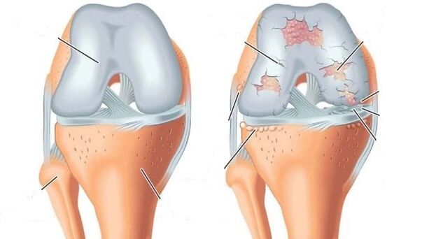 zdravý kloub a artróza kolenního kloubu
