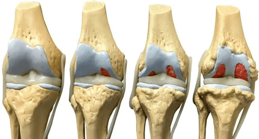 poškození kolenního kloubu v různých fázích vývoje artrózy