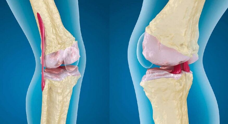 zdravý kloub a artróza kolenního kloubu