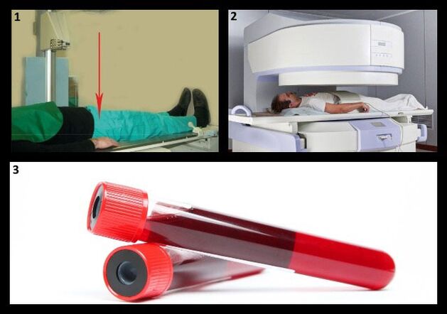 Metody diagnostiky koxartrózy - rentgenové a MRI kyčelního kloubu, krevní test