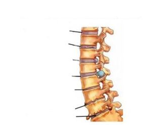 Příznaky osteochondrosy
