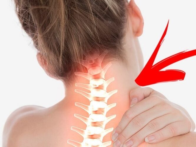 Komprese nervových kořenů s cervikální osteochondózou
