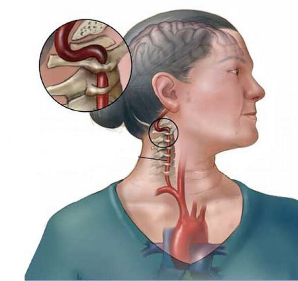 syndrom vertebrální artérie s cervikální osteochondrózou