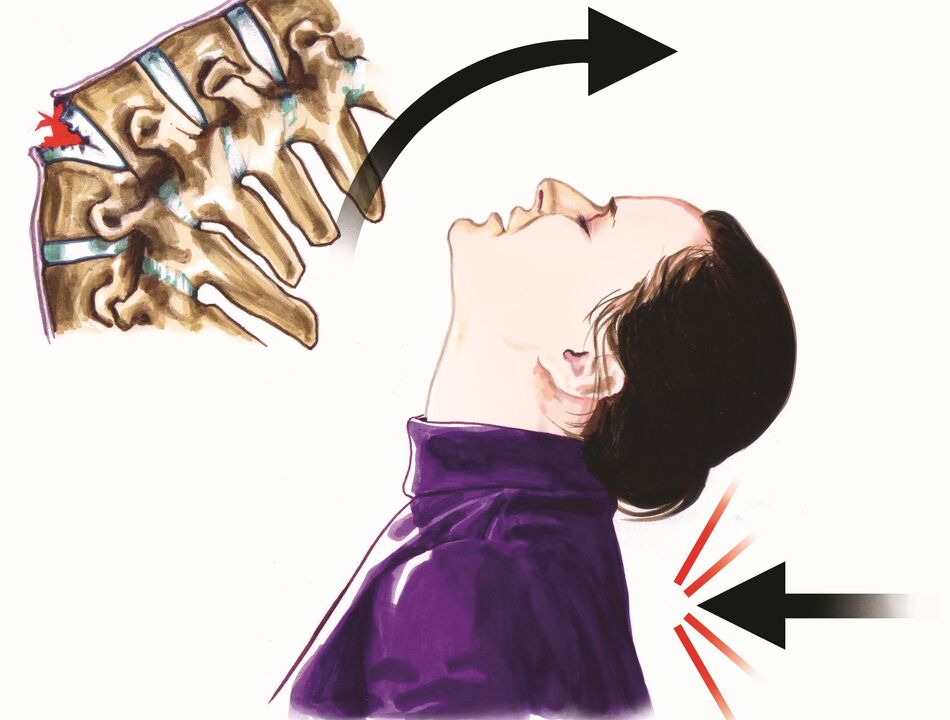 poškození páteře jako příčina bolesti krku